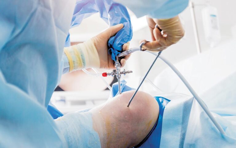 Arthroscopic Knee Surgery