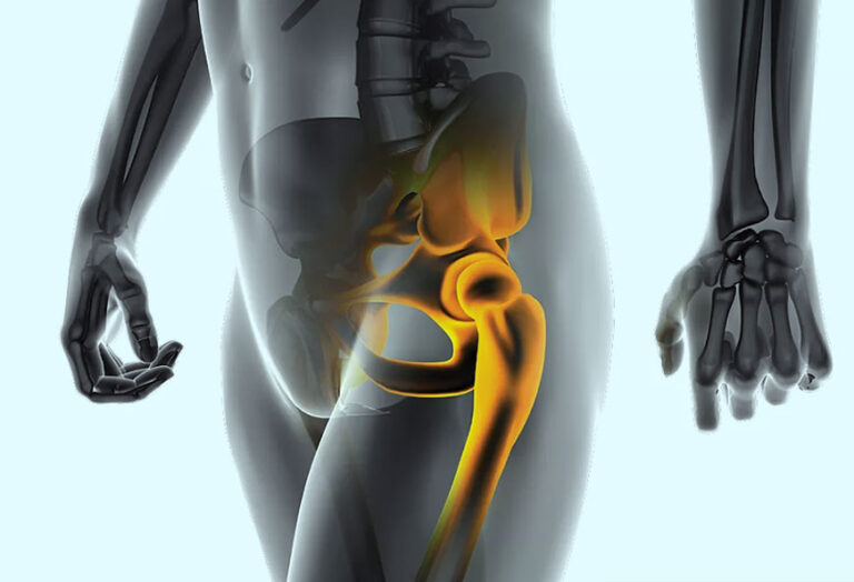 Hip Replacement Surgery
