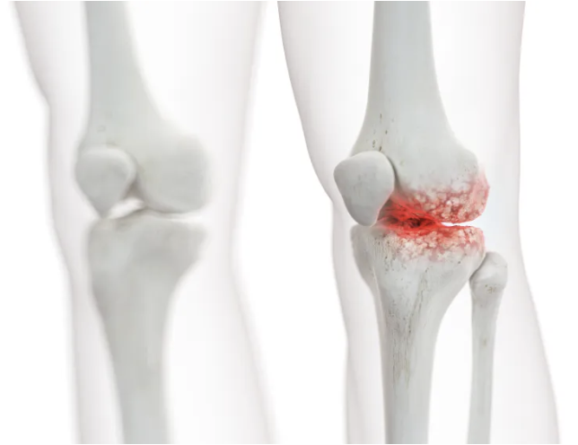 Periprosthetic Joint Infection