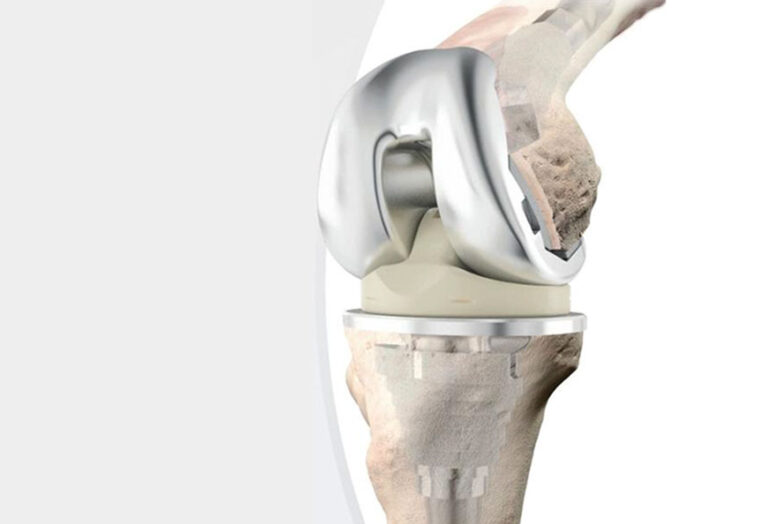 Revision Joint Replacement